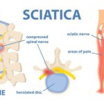 que es la ciatica y cuales son sus causas min